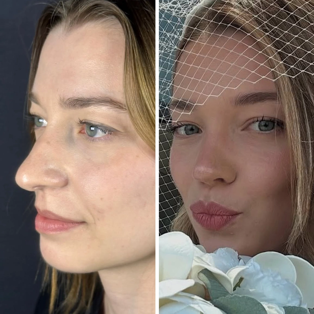 Rhinoplasty before & after — Case 01
