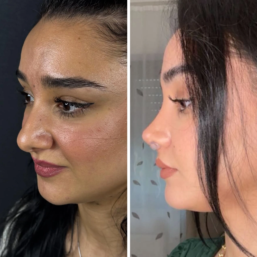 Rhinoplasty before & after — Case 02