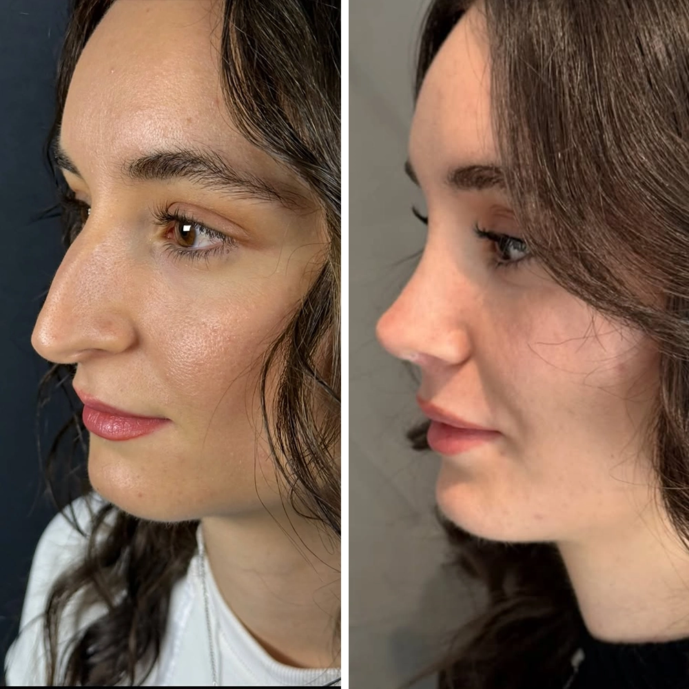 Septorhinoplasty before & after — Case 04