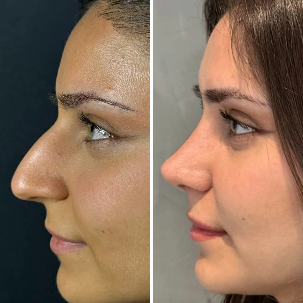 Rhinoplasty before & after — Case 05