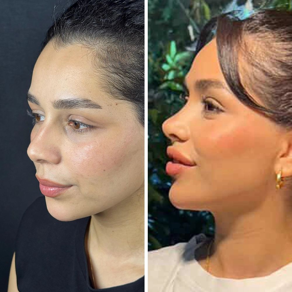 Revision rhinoplasty before & after — Case 03
