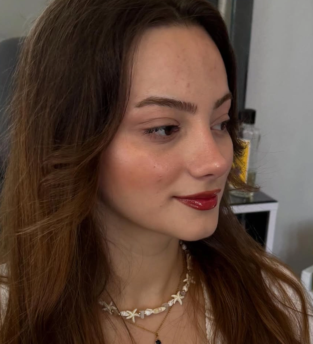 Barbie rhinoplasty result — Op. Dr. Özlem Oymak, Acıbadem Bursa Hospital