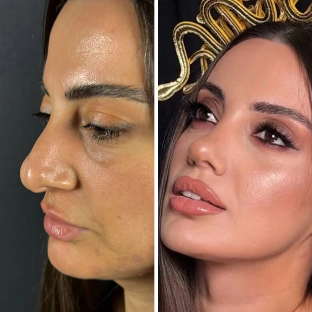 Rhinoplasty before & after — Case 06