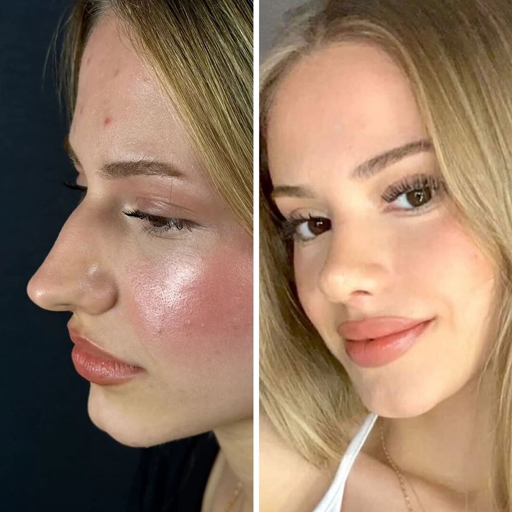 Rhinoplasty before & after — Case 08