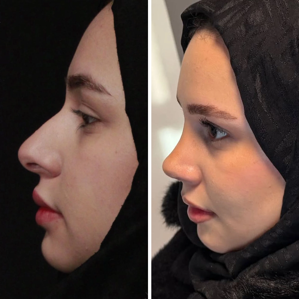 Rhinoplasty before & after — Case 09