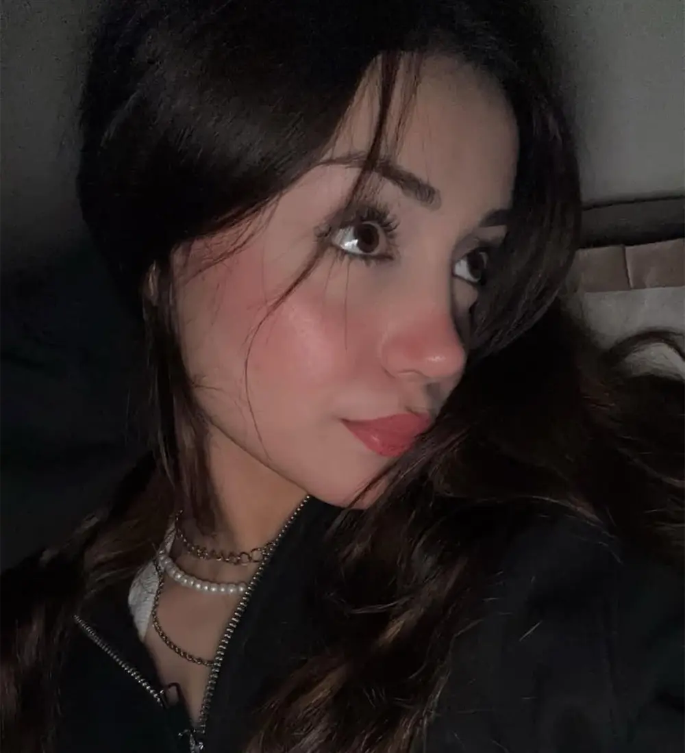 Refined tip rhinoplasty result — Op. Dr. Özlem Oymak, Acıbadem Bursa Hospital